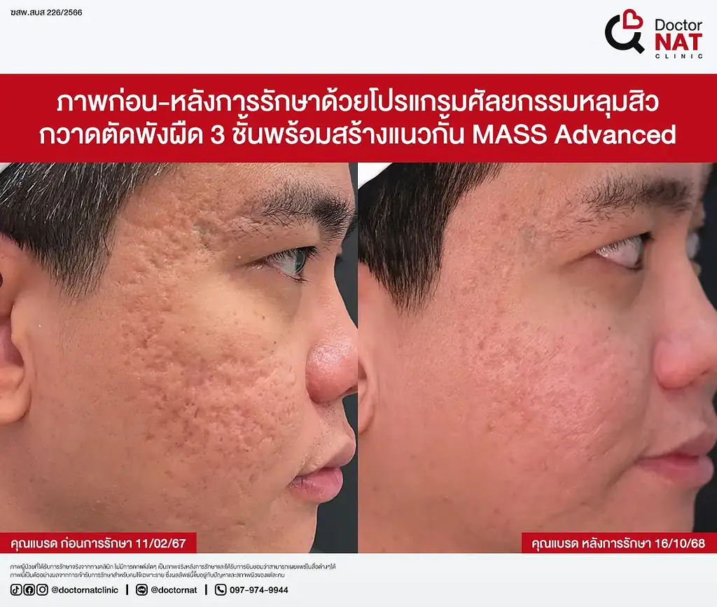 ซูมหลุมสิวเรื้อรัง 20 ปีที่เริ่มตื้นขึ้น