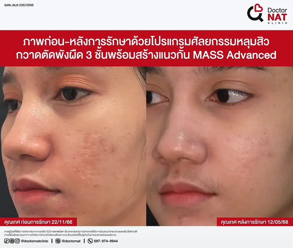 Close-up ผิวหลัง MASS Surgery 3 เดือน
