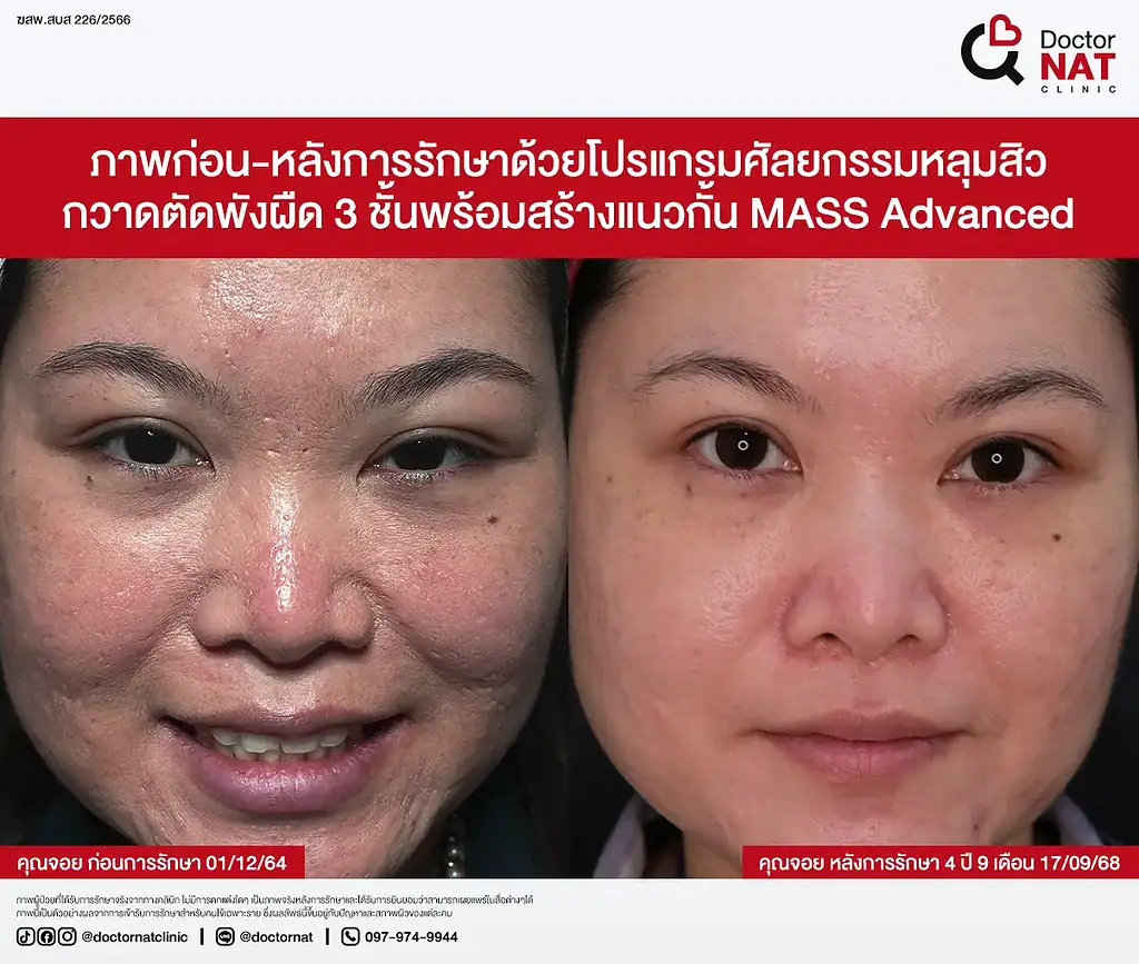 หลุมสิวดีขึ้น 50% หลังรักษากับหมอแนท