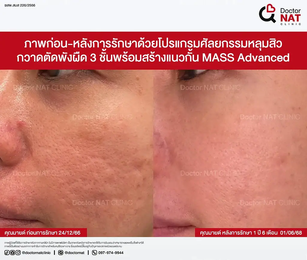 ภาพก่อนรักษาหลุมสิว 10 ปีของคุณมายด์