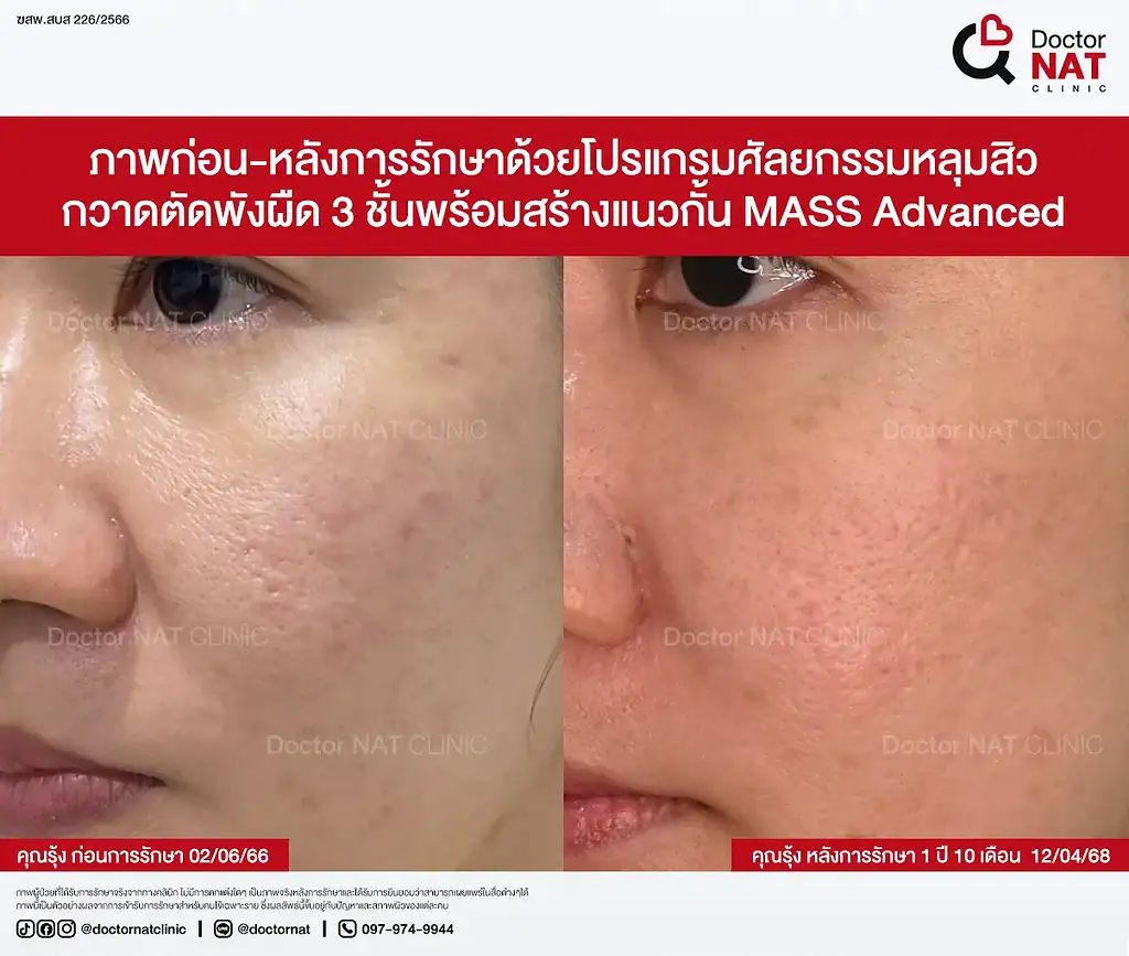 ภาพหลุมสิวบริเวณแก้มและขมับคุณรุ้ง ก่อนทำ MASS Surgery