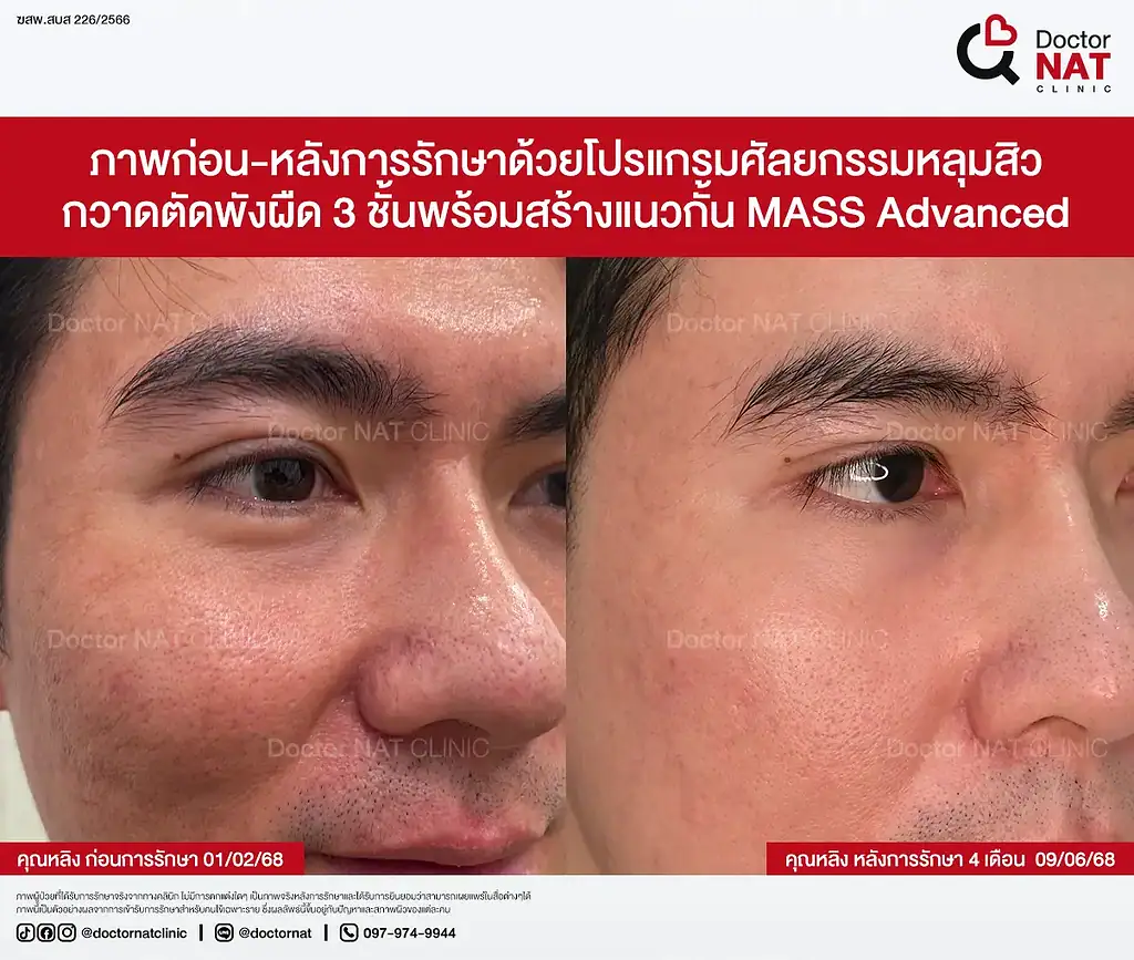 Before หลังทำ Pico และ Subcision หลายรอบแต่ยังไม่ดีขึ้น