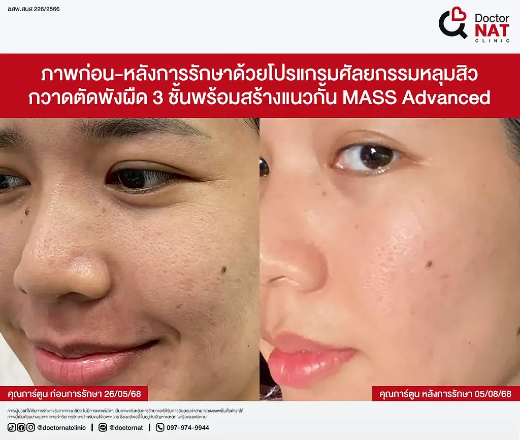 หลุมสิวคุณเกศ ตื้นขึ้นชัดเจนหลังรักษากับหมอแนท