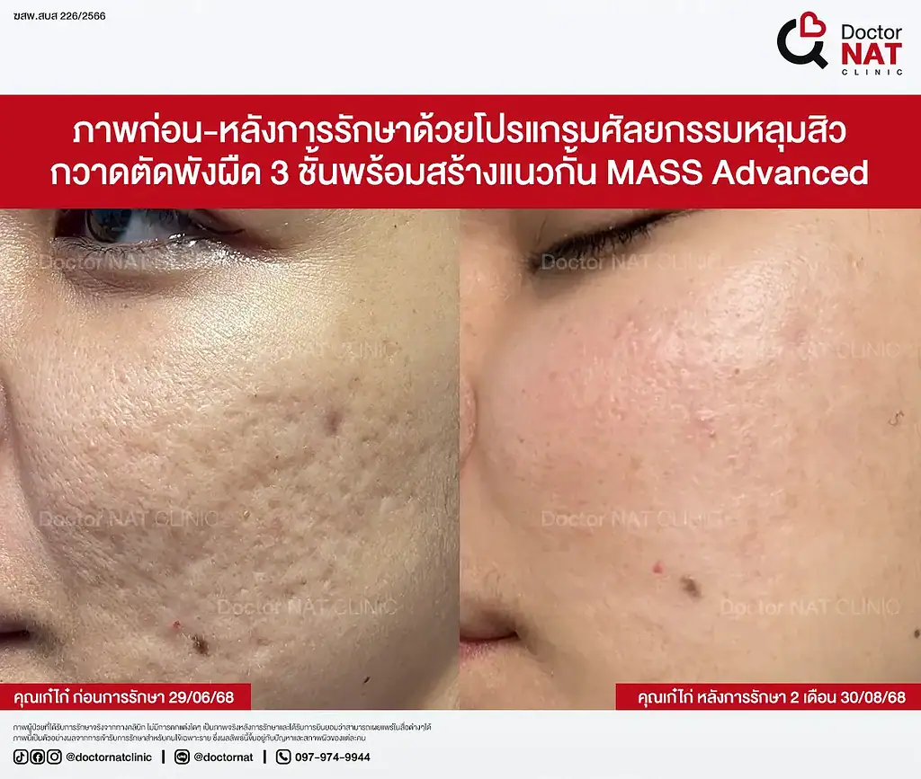 หลุมสิวตื้นขึ้นต่อเนื่องหลังตัดพังผืด 3 ชั้น