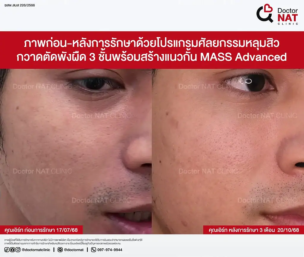 หลุมสิวเรื้อรัง 7 ปีของคุณเอิร์ท ก่อนฟื้นฟู