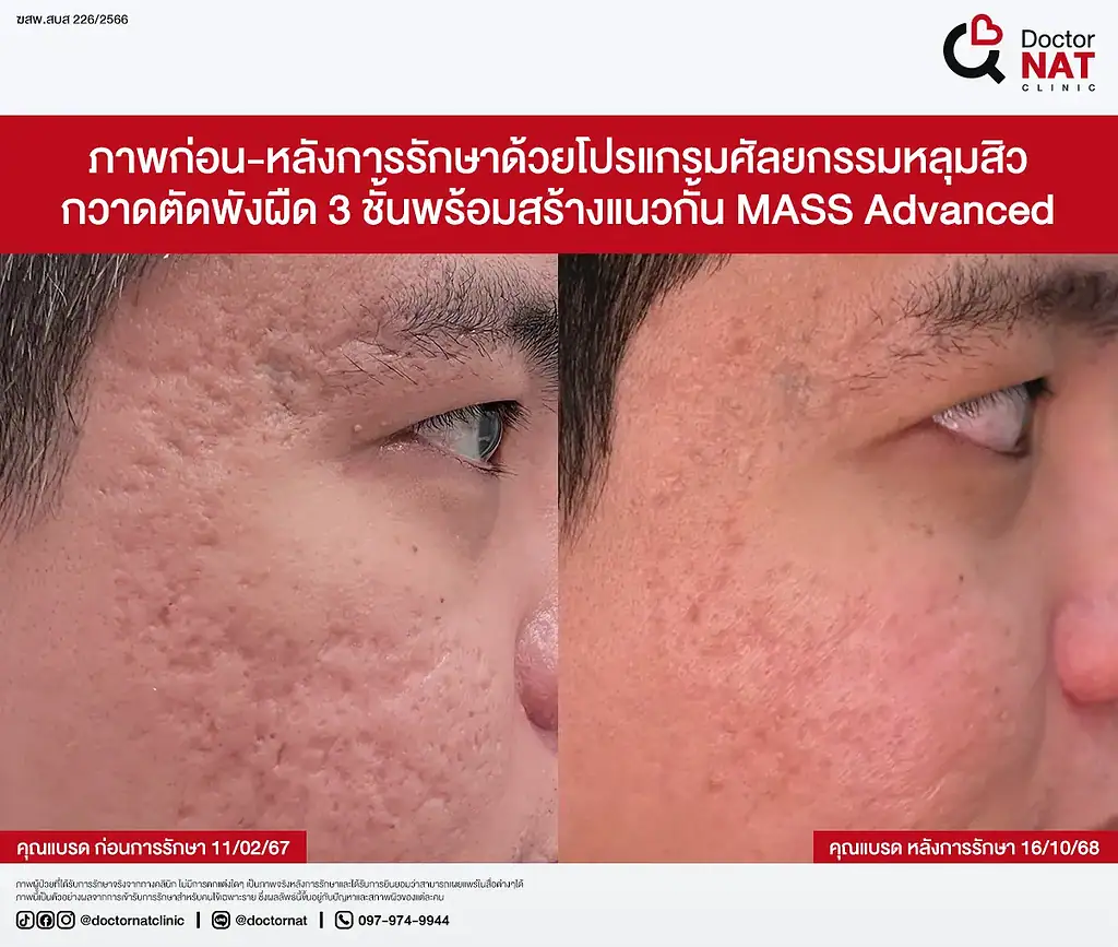 ซูมหลุมสิวเรื้อรัง 20 ปีที่เริ่มตื้นขึ้น