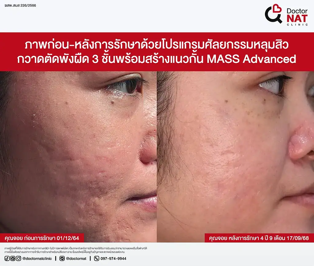 หลุมสิวดีขึ้น 50% หลังรักษากับหมอแนท