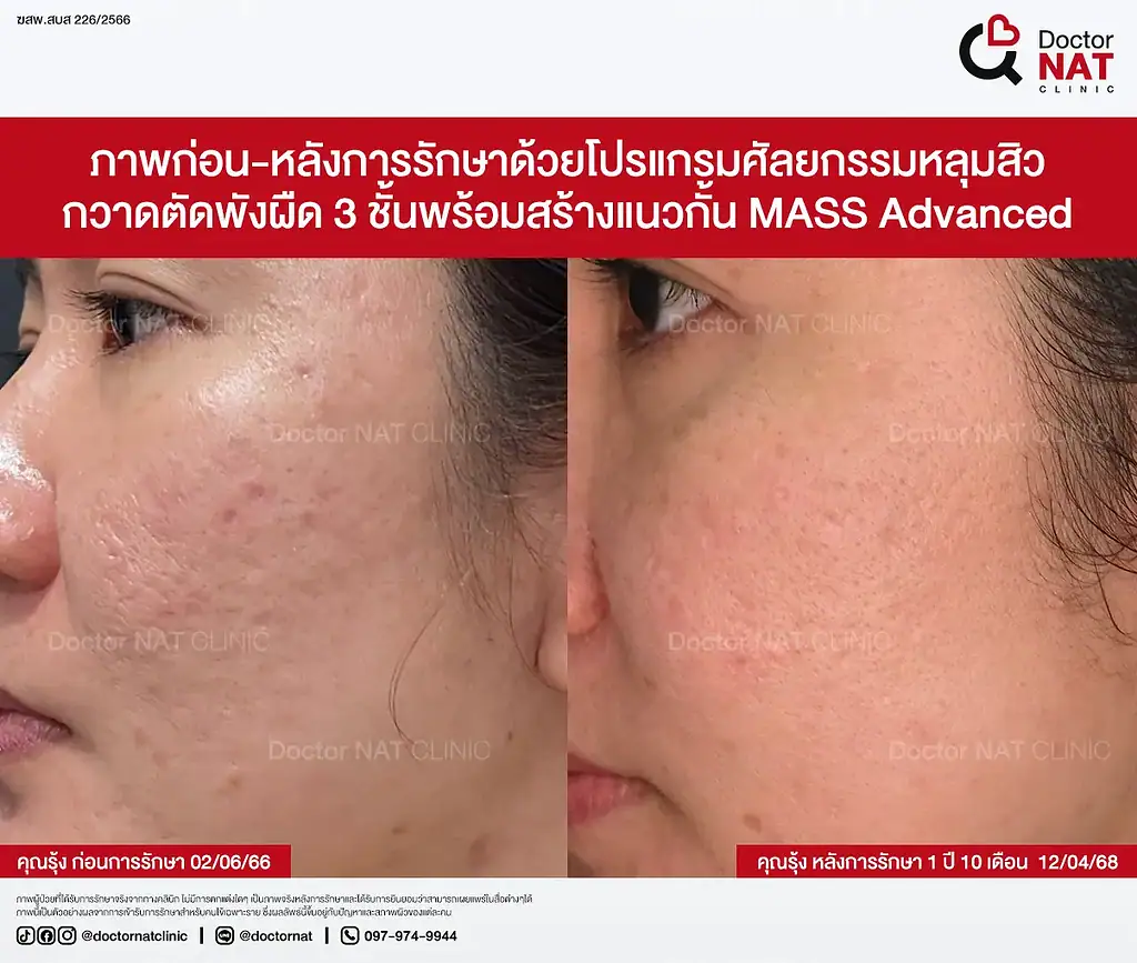 ภาพหลุมสิวบริเวณแก้มและขมับคุณรุ้ง ก่อนทำ MASS Surgery