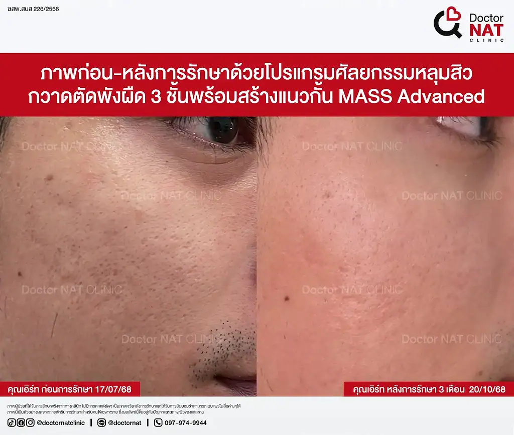 หลุมสิวเรื้อรัง 7 ปีของคุณเอิร์ท ก่อนฟื้นฟู