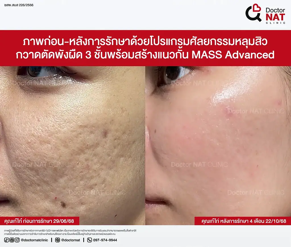 หลุมสิวตื้นขึ้นต่อเนื่องหลังตัดพังผืด 3 ชั้น