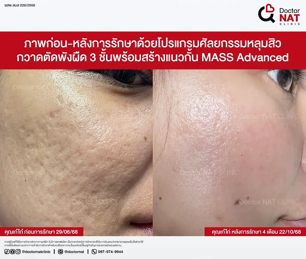 หลุมสิวตื้นขึ้นต่อเนื่องหลังตัดพังผืด 3 ชั้น