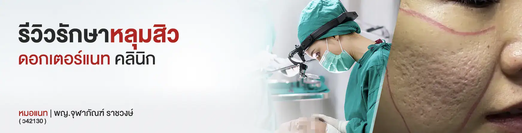 รีวิวรักษาหลุมสิว Doctor NAT Clinic