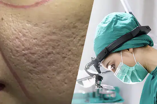 โปรแกรมศัลยกรรมกวาดตัดพังผืดหลุมสิว 3 ชั้น MASS Advanced