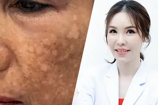 โปรแกรมรักษาฝ้าอย่างแม่นยำ
ไม่ใช้ความร้อน
MISS