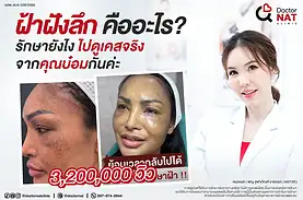 ฝ้าฝังลึก คืออะไร รักษาได้ไหม? | Doctor NAT Clinic