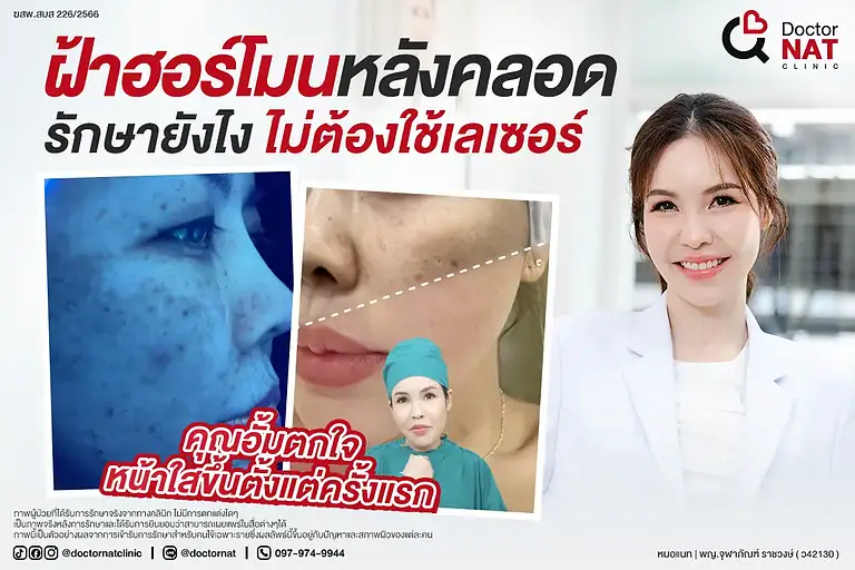 เคสจริงจากคุณอั้ม ที่ต่อสู้กับฝ้าฮอร์โมนกว่า 8 ปี ก่อนพบทางออกกับโปรแกรม MISS จากหมอแนท