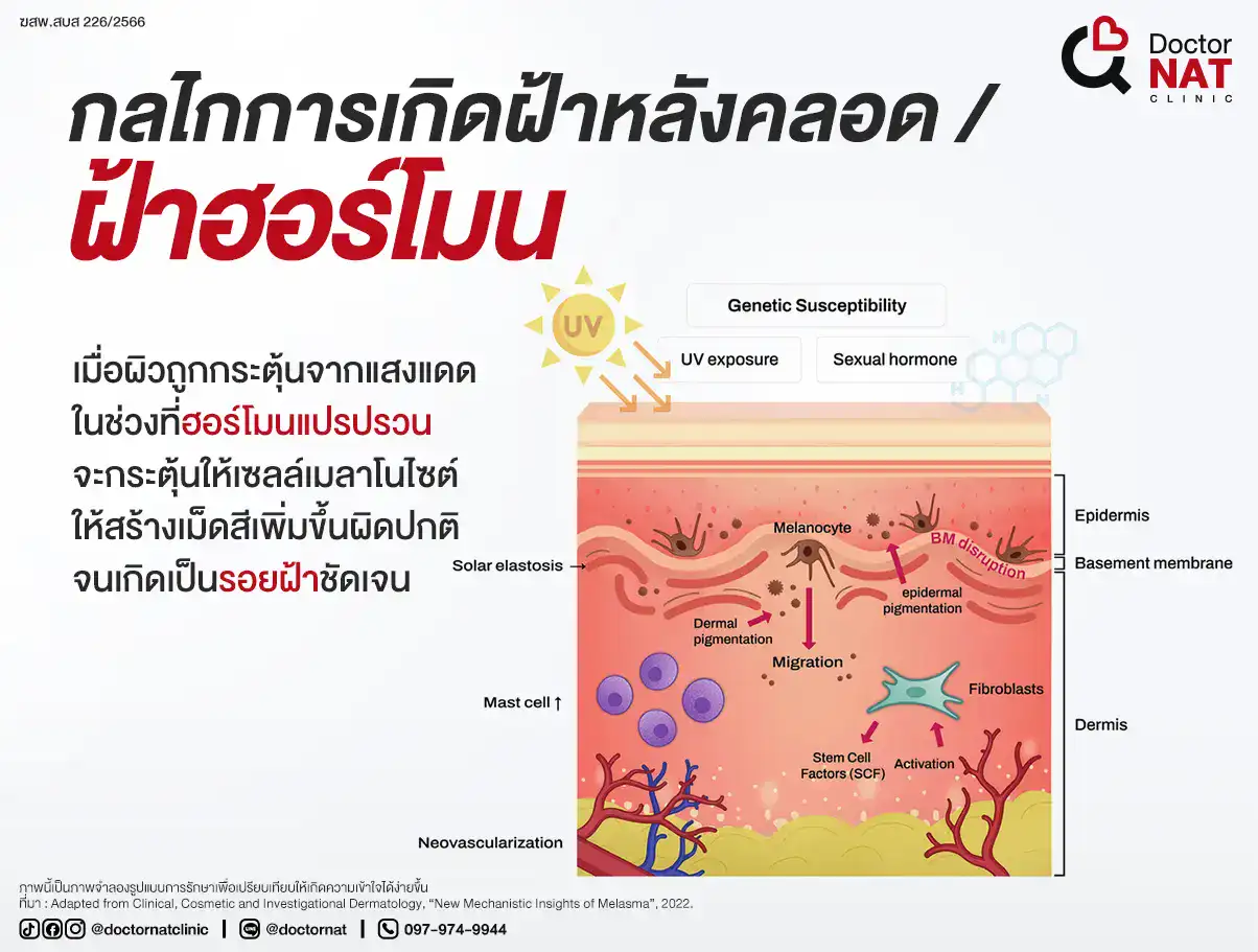 กลไกการเกิดฝ้าหลังคลอด / ฝ้าฮอร์โมน
