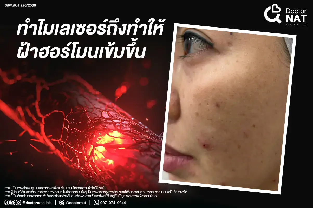 ทำไมเลเซอร์ถึงทำให้ฝ้าฮอร์โมนเข้มขึ้น