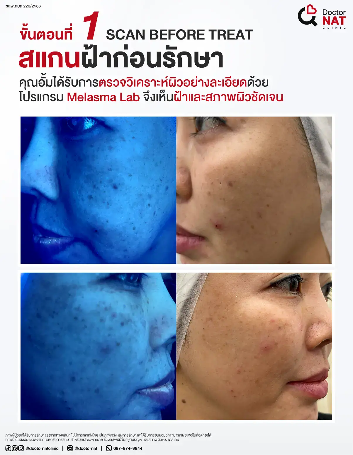 ขั้นตอนที่ 1
Scan Before Treat - สแกนฝ้าก่อนรักษา