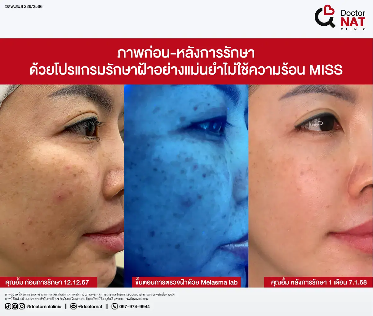 ภาพก่อน-หลังการรักษา ฝ้าฮอร์โมน
ด้วยโปรแกรมรักษาฝ้าอย่างแม่นยำไม่ใช้ความร้อน MISS