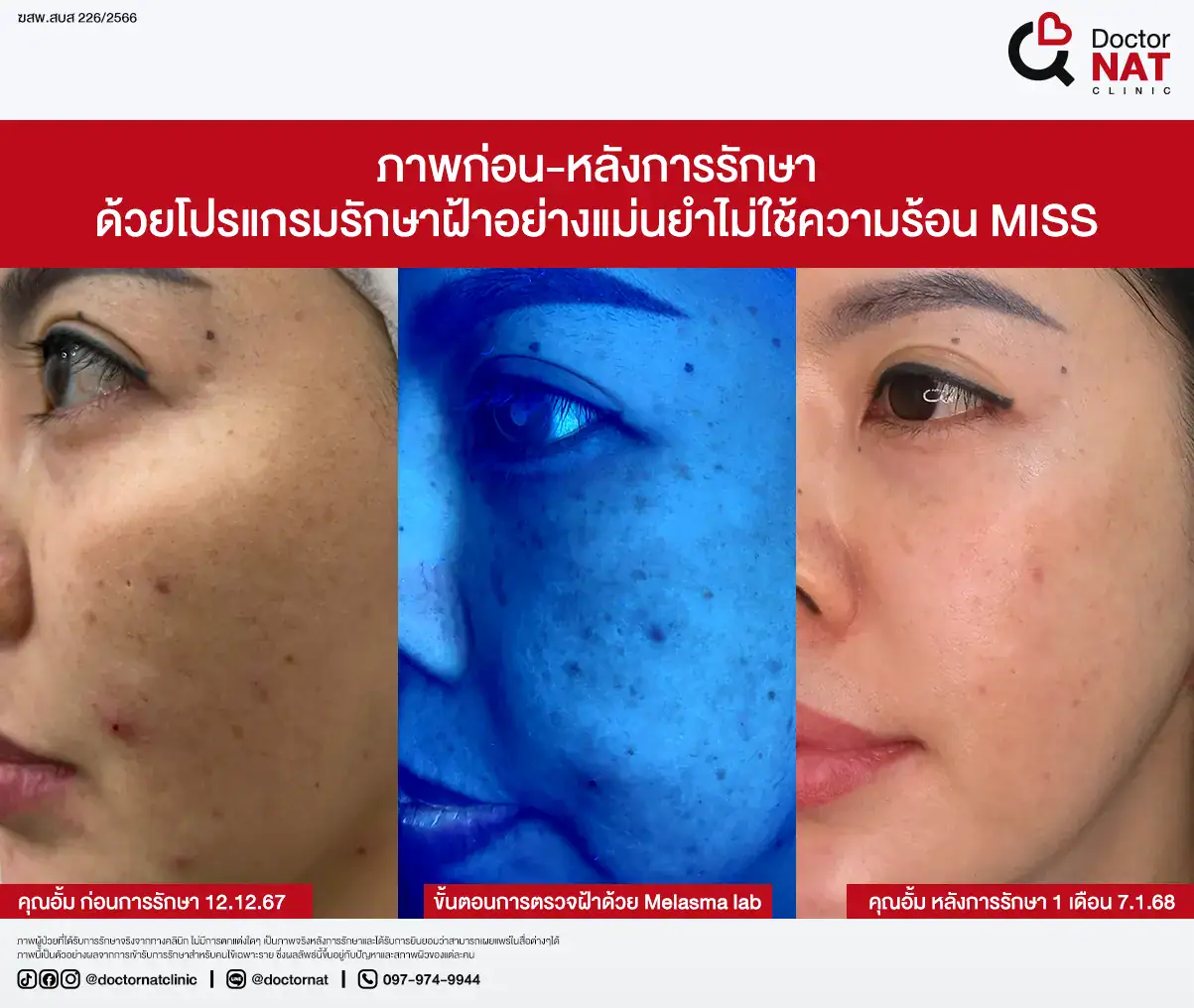 ภาพก่อน-หลังการรักษา ฝ้าฮอร์โมน
ด้วยโปรแกรมรักษาฝ้าอย่างแม่นยำไม่ใช้ความร้อน MISS
