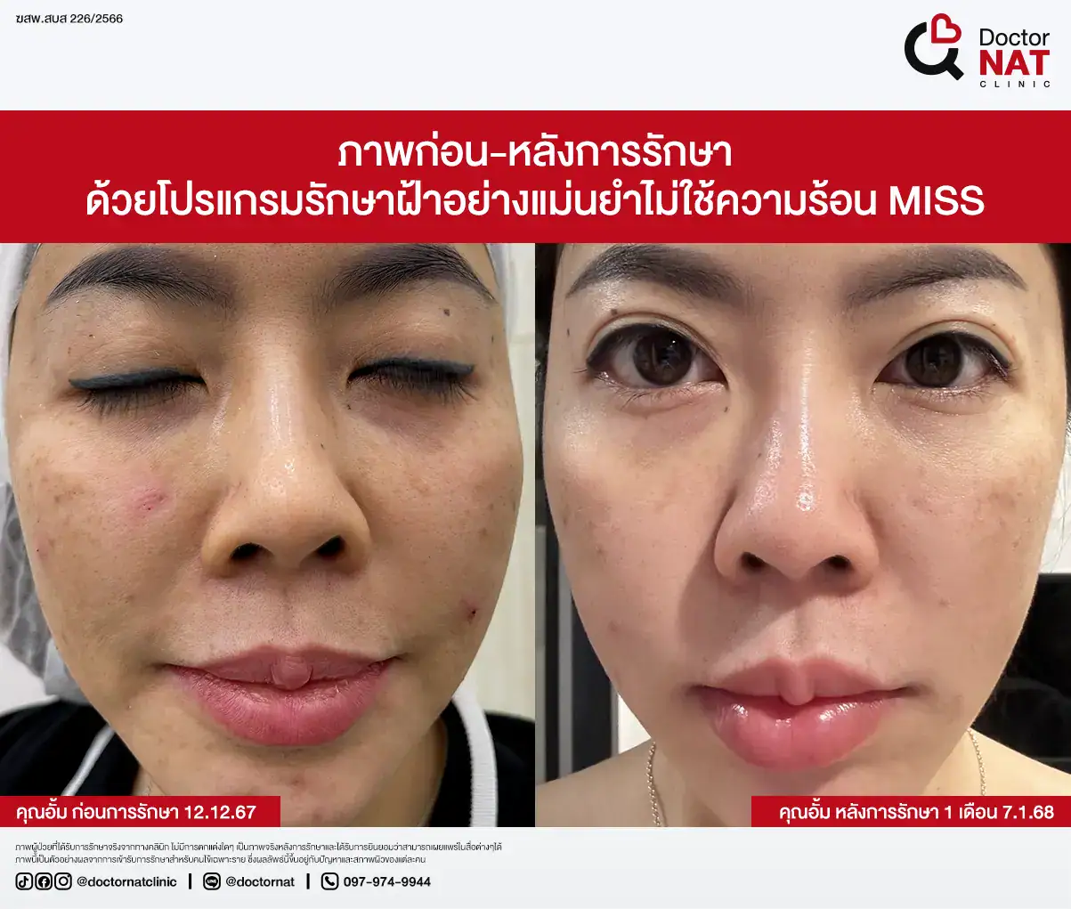 ภาพก่อน-หลังการรักษา ฝ้าฮอร์โมน
ด้วยโปรแกรมรักษาฝ้าอย่างแม่นยำไม่ใช้ความร้อน MISS