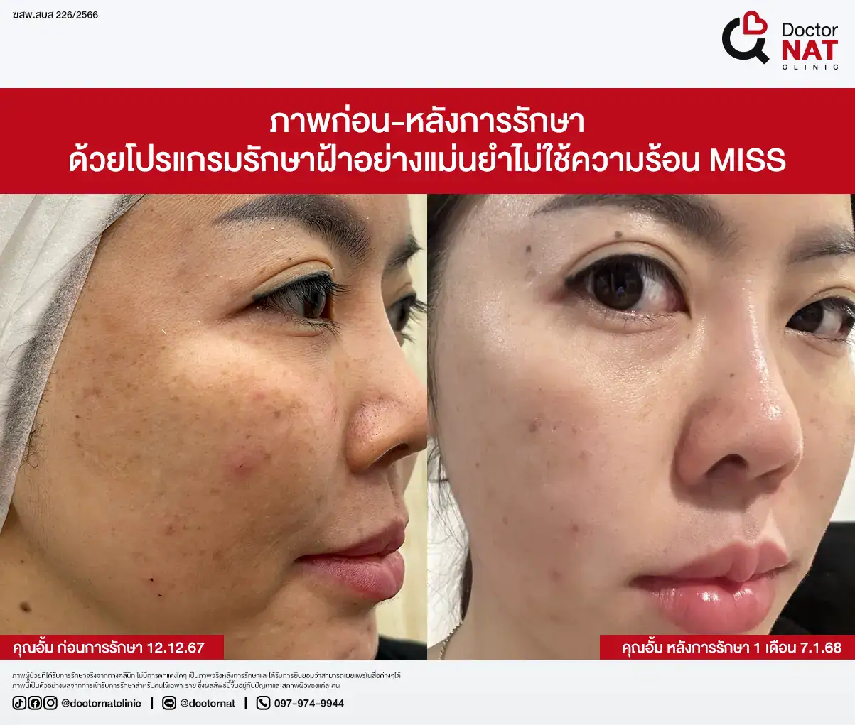 ภาพก่อน-หลังการรักษา ฝ้าฮอร์โมน
ด้วยโปรแกรมรักษาฝ้าอย่างแม่นยำไม่ใช้ความร้อน MISS