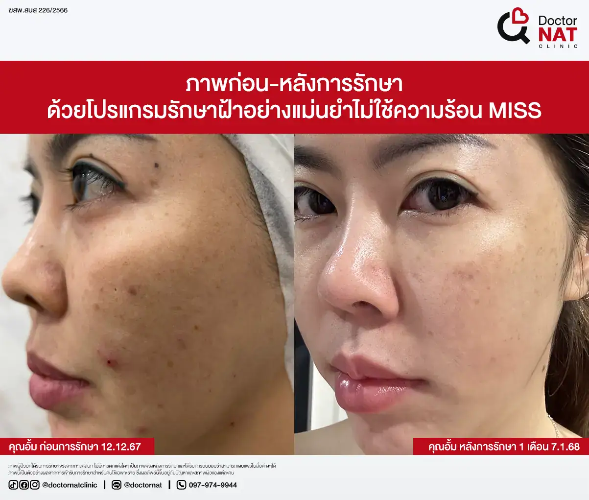 ภาพก่อน-หลังการรักษา ฝ้าฮอร์โมน
ด้วยโปรแกรมรักษาฝ้าอย่างแม่นยำไม่ใช้ความร้อน MISS