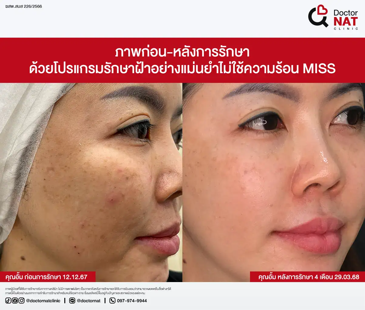 ภาพก่อน-หลังการรักษา ฝ้าฮอร์โมน
ด้วยโปรแกรมรักษาฝ้าอย่างแม่นยำไม่ใช้ความร้อน MISS