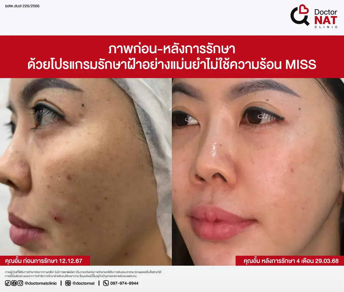 ภาพก่อน-หลังการรักษา ฝ้าฮอร์โมน
ด้วยโปรแกรมรักษาฝ้าอย่างแม่นยำไม่ใช้ความร้อน MISS