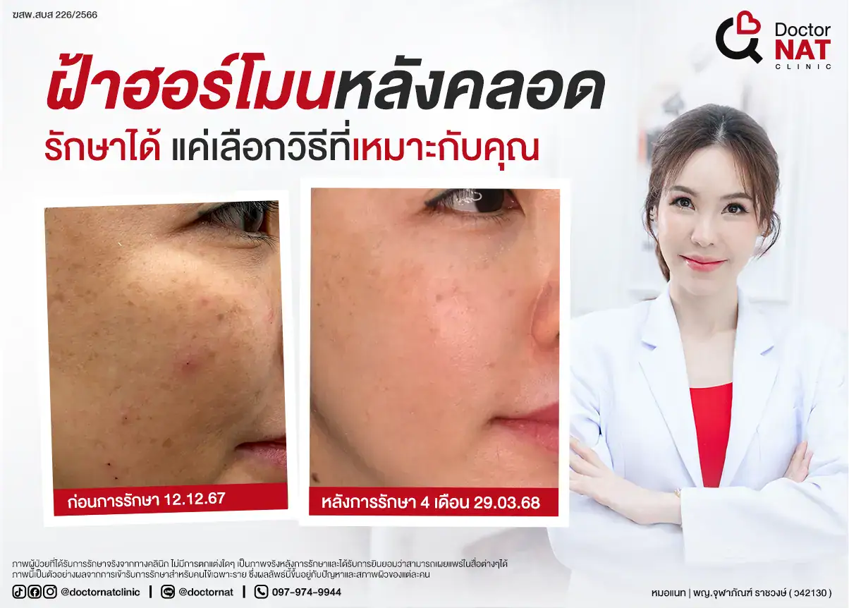 ฝ้าฮอร์โมนหลังคลอด รักษาได้
แค่เลือกวิธีที่เหมาะกับคุณ