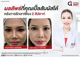 ผลจากการรักษาฝ้า ที่ดอกเตอร์ แนท คลินิก