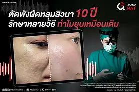 เตรียมผิวก่อนตัดพังผืดสำคัญอย่างไร?