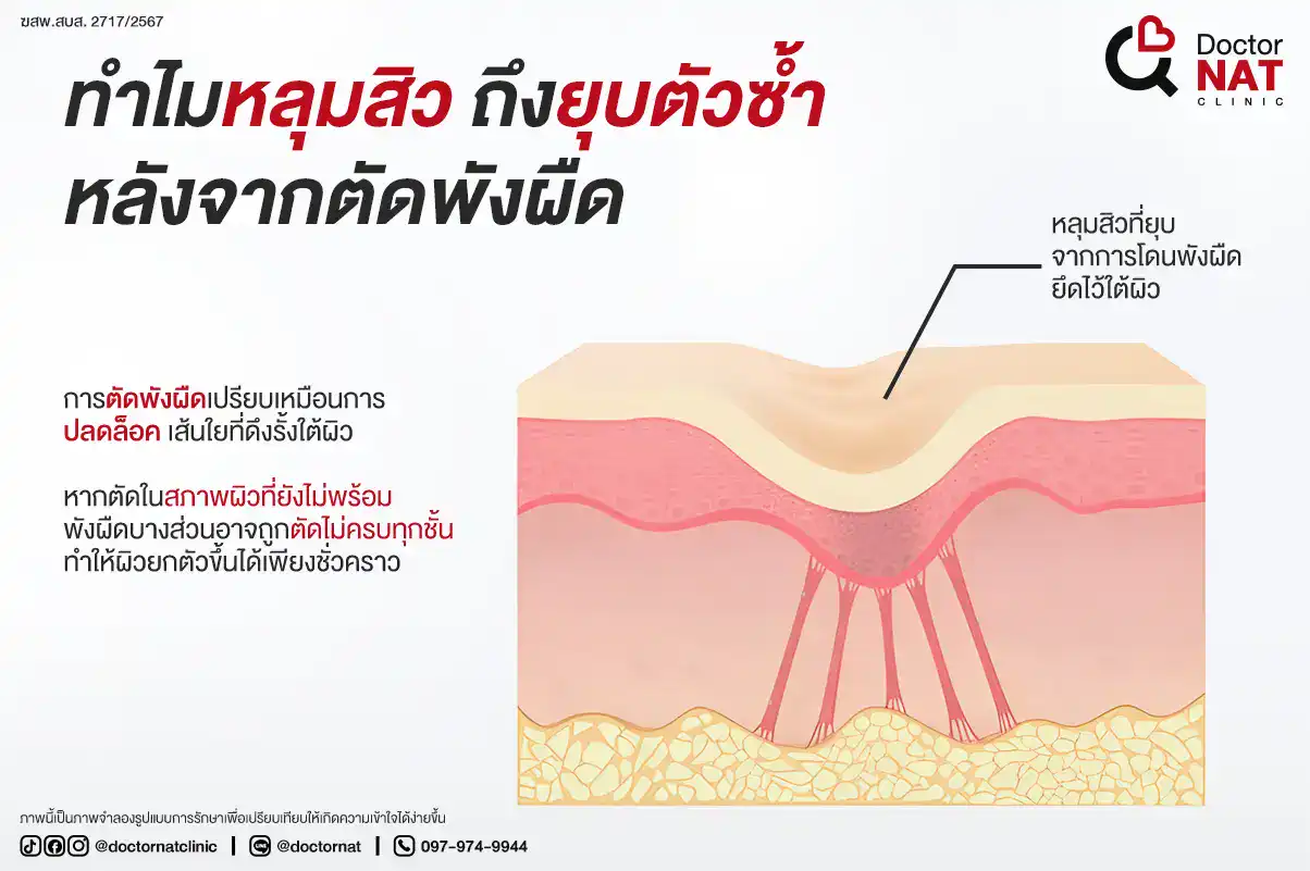 เตรียมผิวก่อนตัดพังผืดสำคัญอย่างไร?