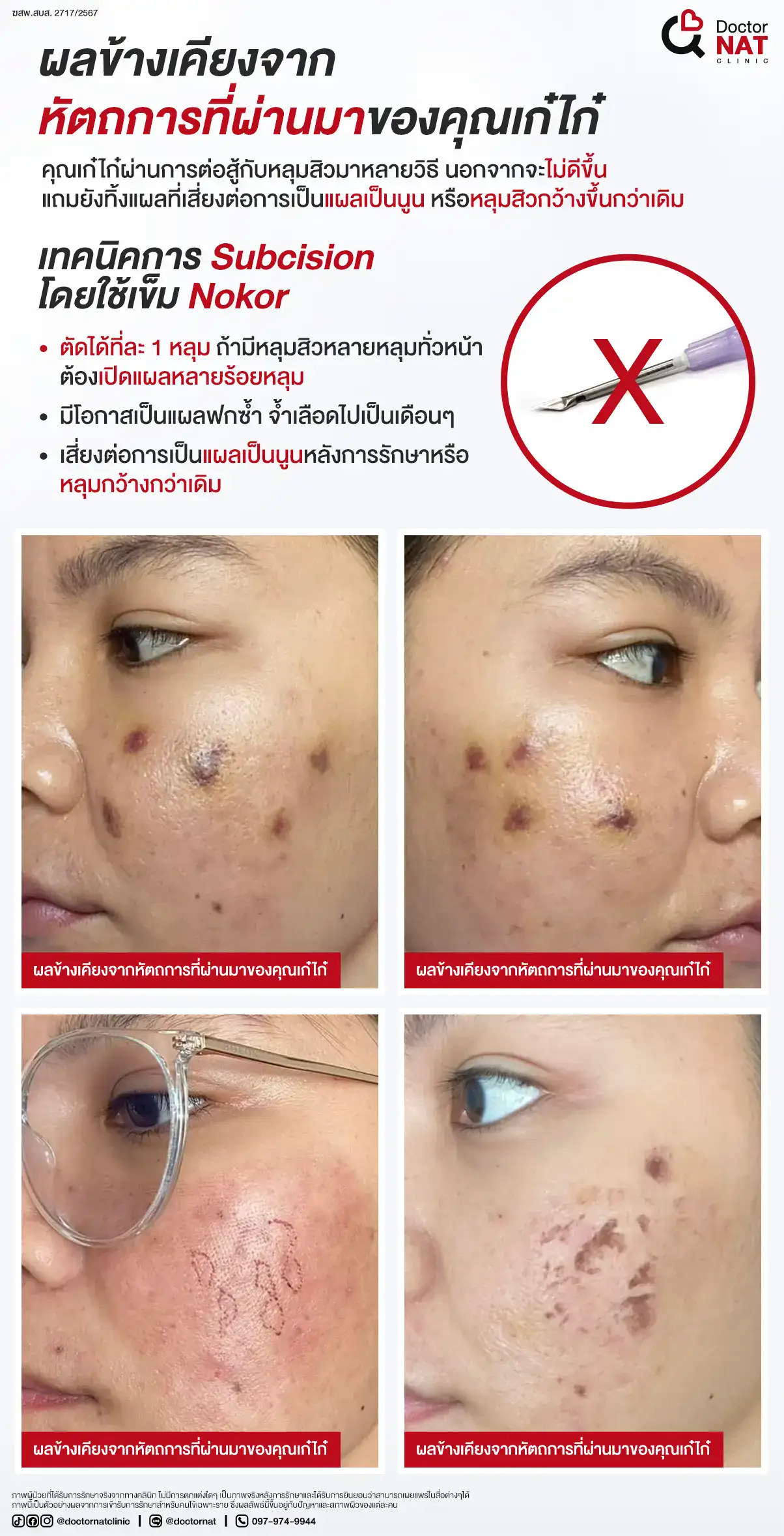 ผลข้างเคียงจากการ subcision