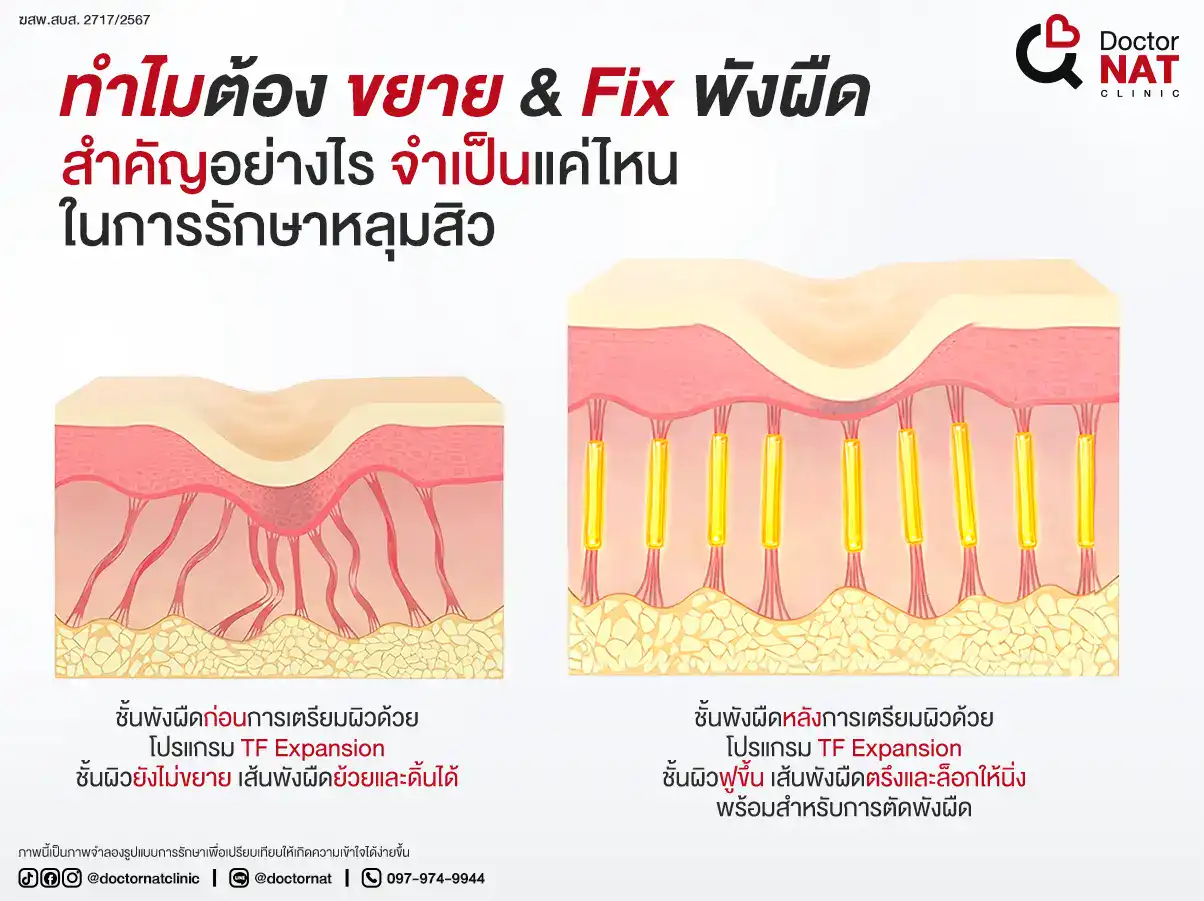 ทำไมต้อง ขยาย & Fix พังผืด