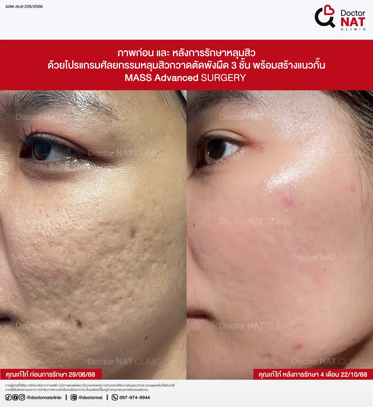 ภาพก่อน-หลังการรักษาหลุมสิว ของคุณตุ๊กติ๊ก
ด้วยโปรแกรมศัลยกรรมหลุมสิวกวาดตัดพังผืด 3 ชั้น พร้อมสร้างแนวกั้น
MASS Advanced Surgery