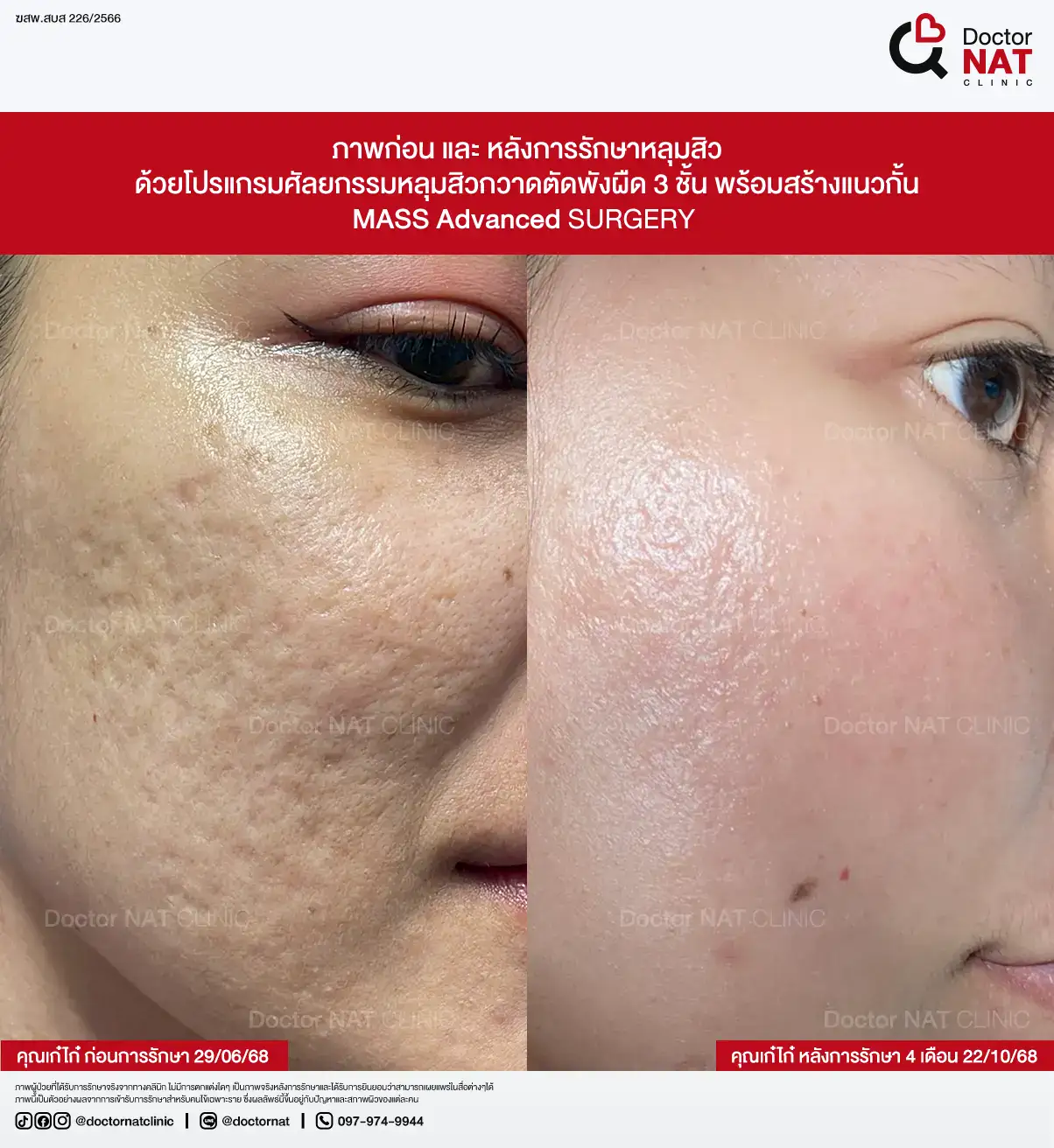 ภาพก่อน-หลังการรักษาหลุมสิว ของคุณตุ๊กติ๊ก
ด้วยโปรแกรมศัลยกรรมหลุมสิวกวาดตัดพังผืด 3 ชั้น พร้อมสร้างแนวกั้น
MASS Advanced Surgery