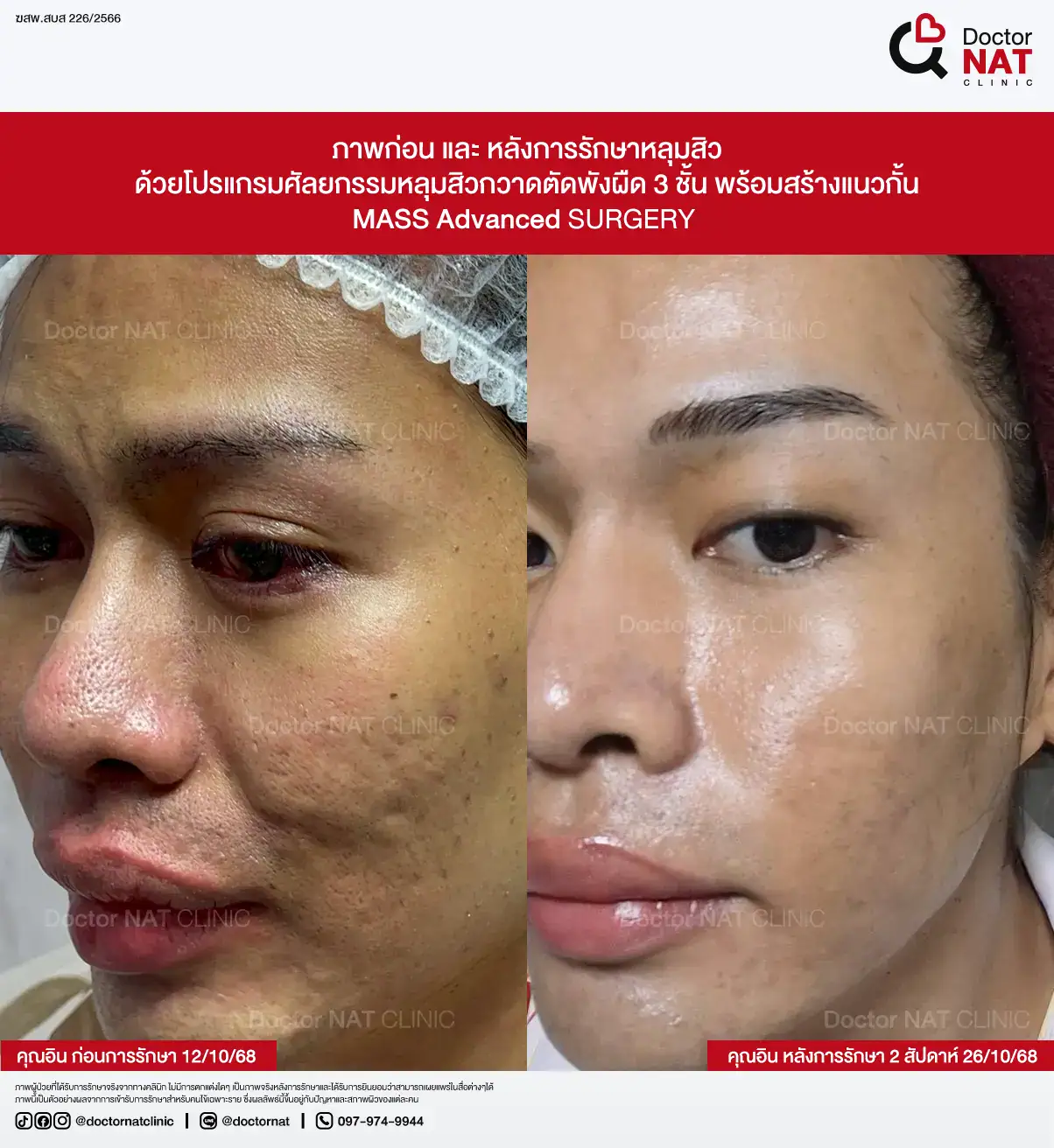 ภาพก่อน-หลังการรักษาหลุมสิว ของคุณตุ๊กติ๊ก
ด้วยโปรแกรมศัลยกรรมหลุมสิวกวาดตัดพังผืด 3 ชั้น พร้อมสร้างแนวกั้น
MASS Advanced Surgery