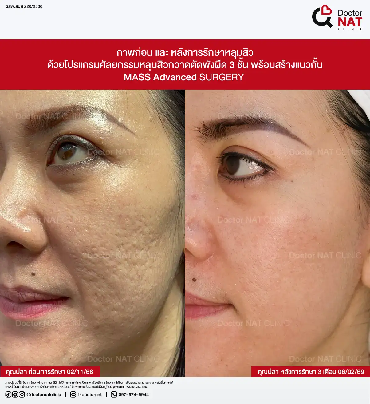 ภาพก่อน-หลังการรักษาหลุมสิว ของคุณตุ๊กติ๊ก
ด้วยโปรแกรมศัลยกรรมหลุมสิวกวาดตัดพังผืด 3 ชั้น พร้อมสร้างแนวกั้น
MASS Advanced Surgery