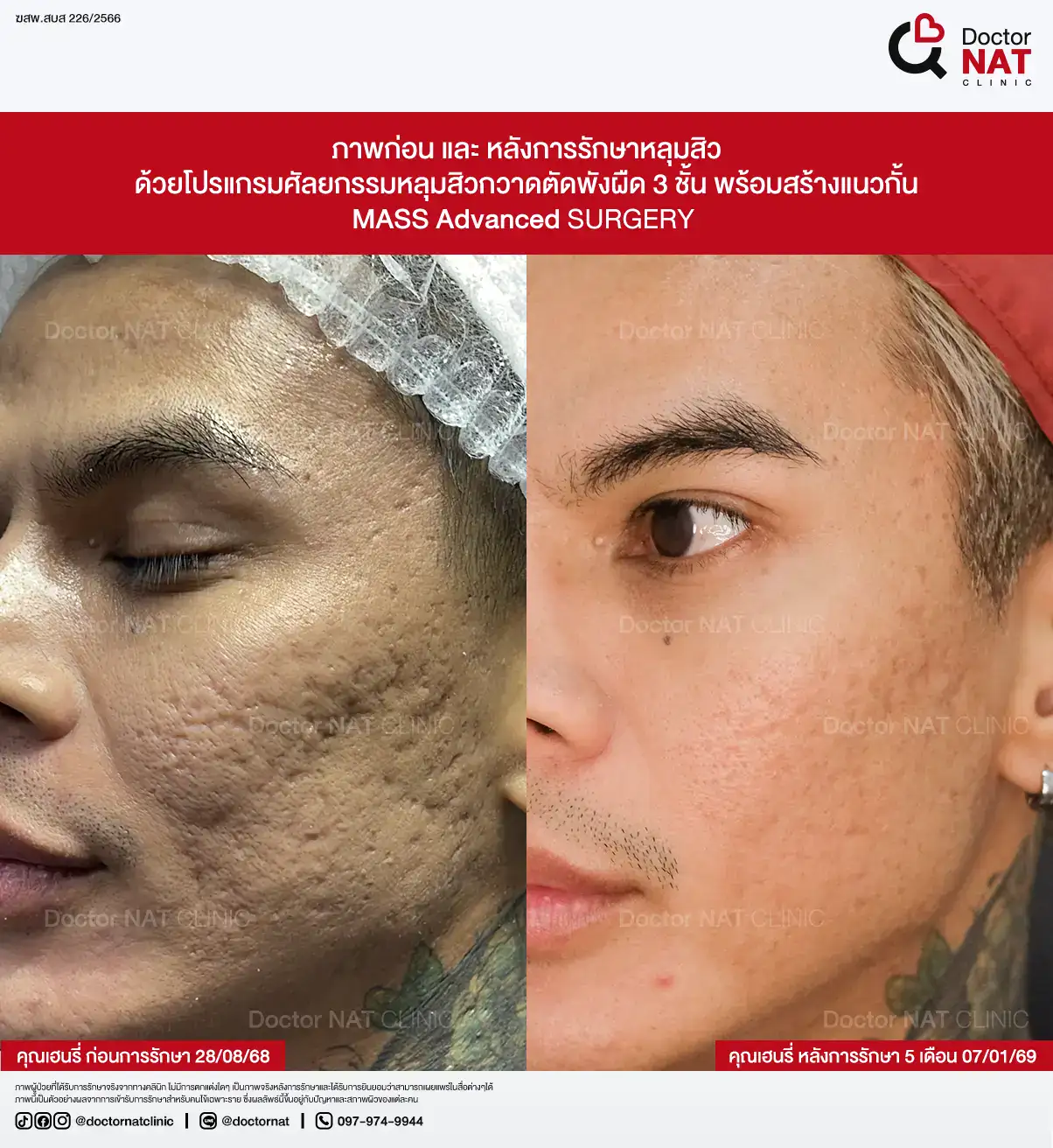 ภาพก่อน-หลังการรักษาหลุมสิว ของคุณตุ๊กติ๊ก
ด้วยโปรแกรมศัลยกรรมหลุมสิวกวาดตัดพังผืด 3 ชั้น พร้อมสร้างแนวกั้น
MASS Advanced Surgery