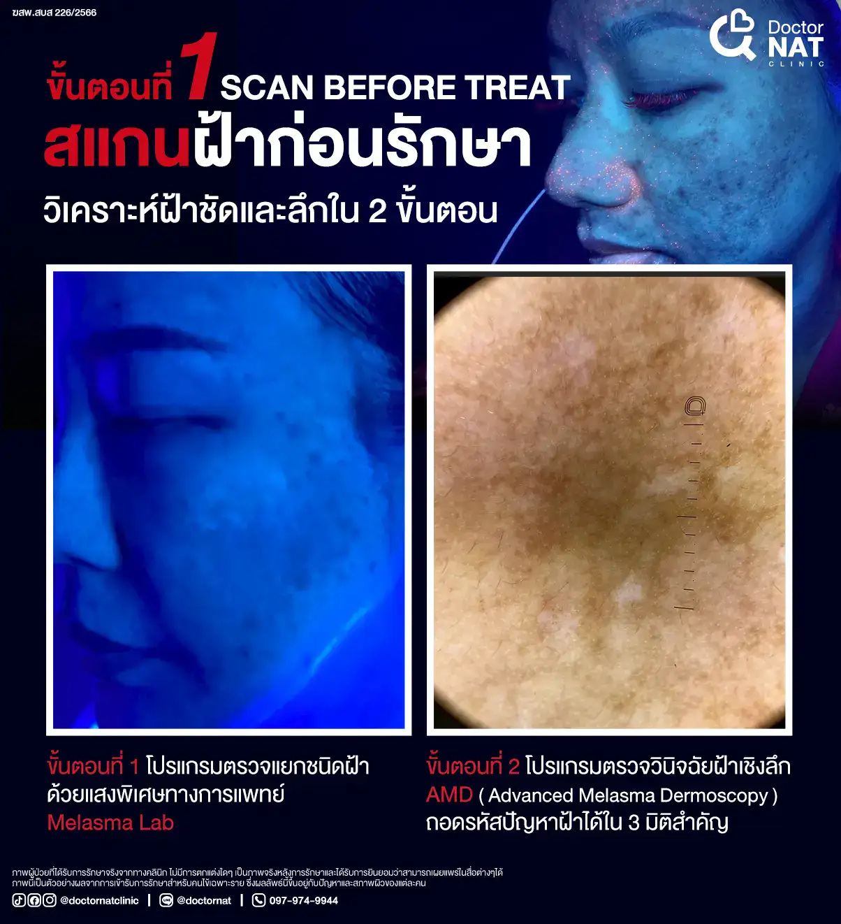 สแกนฝ้าก่อนรักษา 2 ขั้นตอน