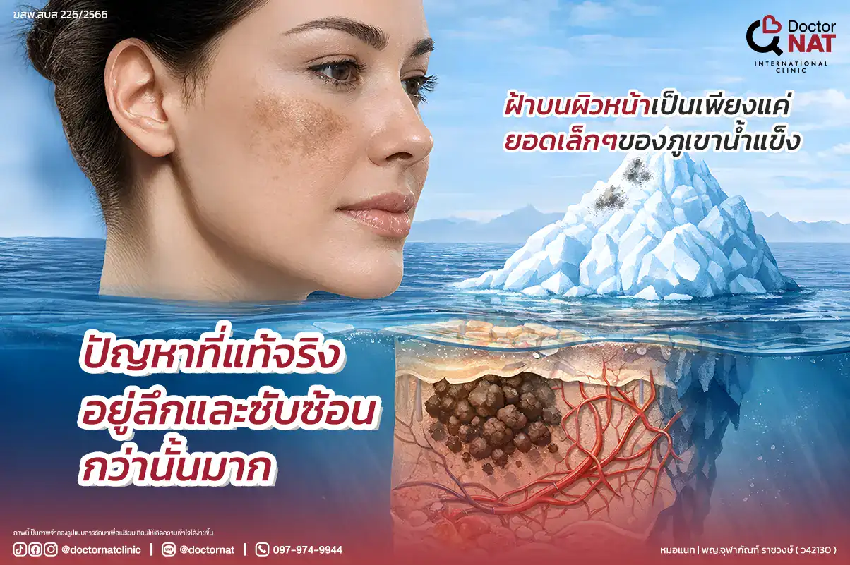 ปัญหาฝ้ากลับมาเป็นซ้ำหลังเลเซอร์ ลอกผิว หรือฉีดฝ้า