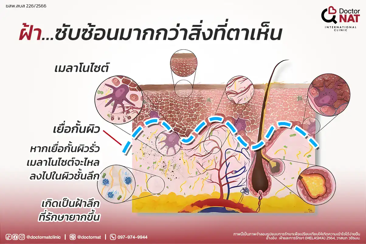 ภาพอธิบายฝ้าที่ซ่อนอยู่ใต้ผิวและมองไม่เห็นด้วยตาเปล่า