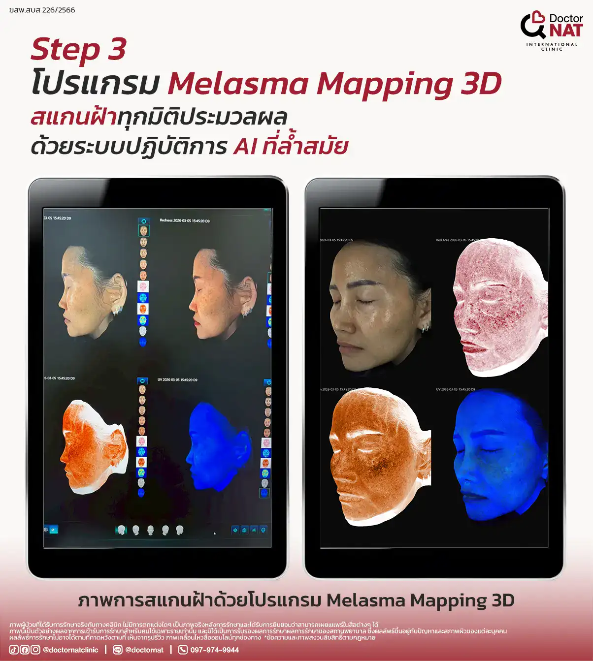 Melasma Lab ตรวจแยกชนิดฝ้าและการตอบสนองของเม็ดสี