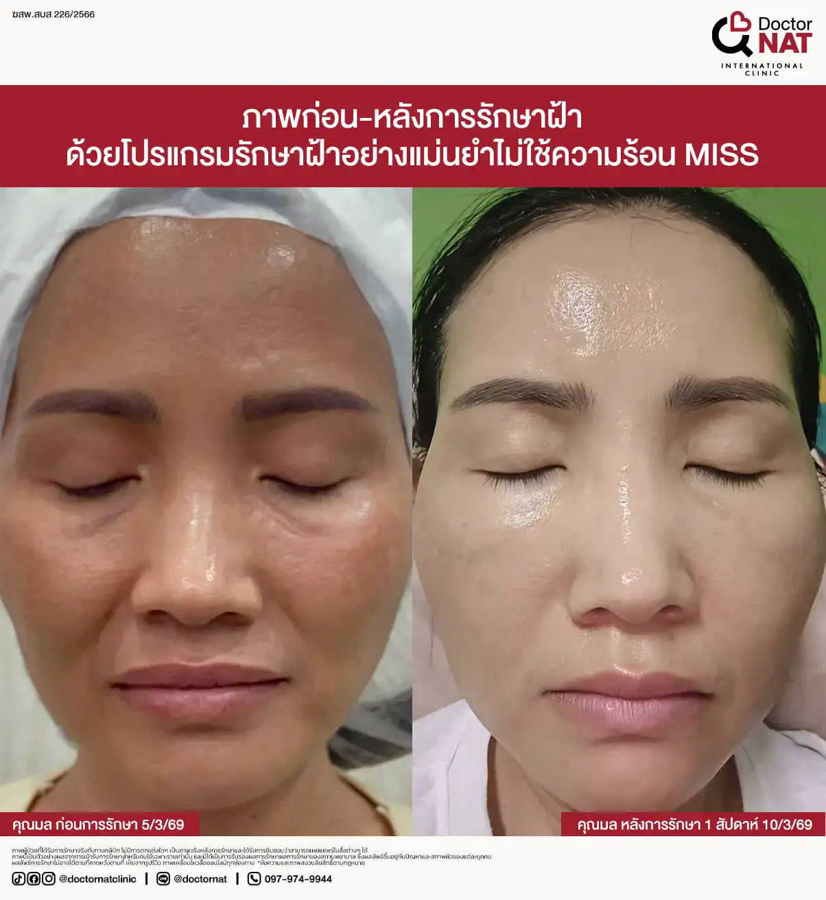Melasma Mapping 3D วิเคราะห์ความลึกและการกระจายของฝ้า