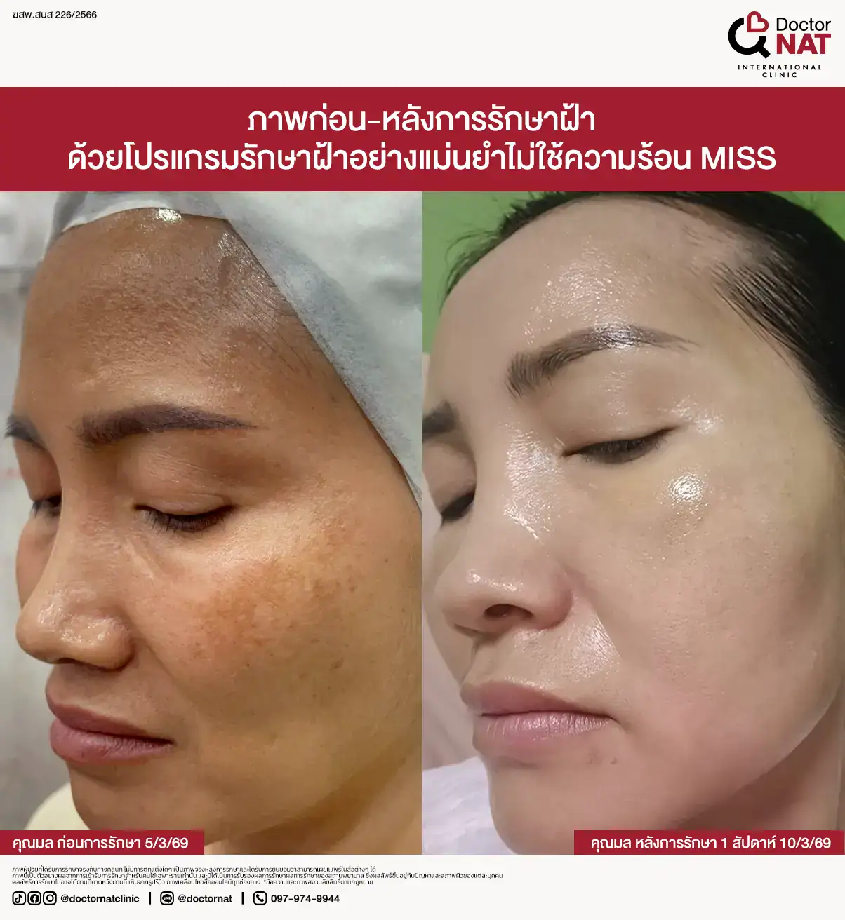 ระบบสแกนผิว 3 มิติสำหรับวางแผนรักษาฝ้า