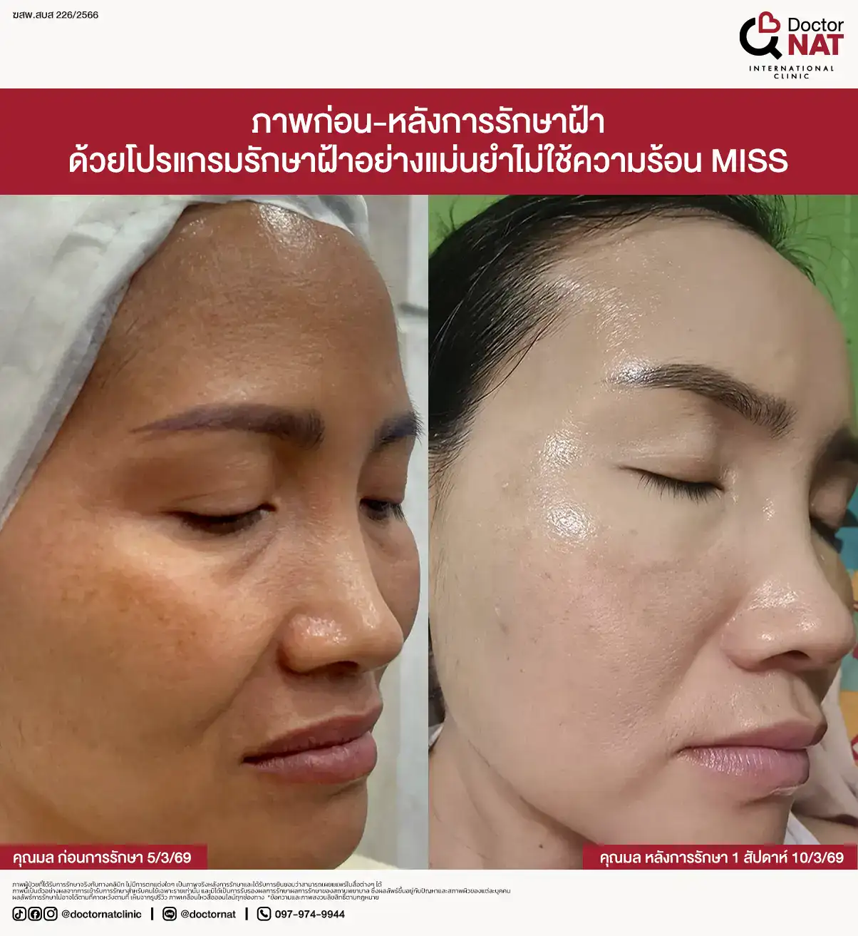 การประเมินฝ้าฝังลึก ฝ้าเลือด และโครงสร้างผิวก่อนรักษา