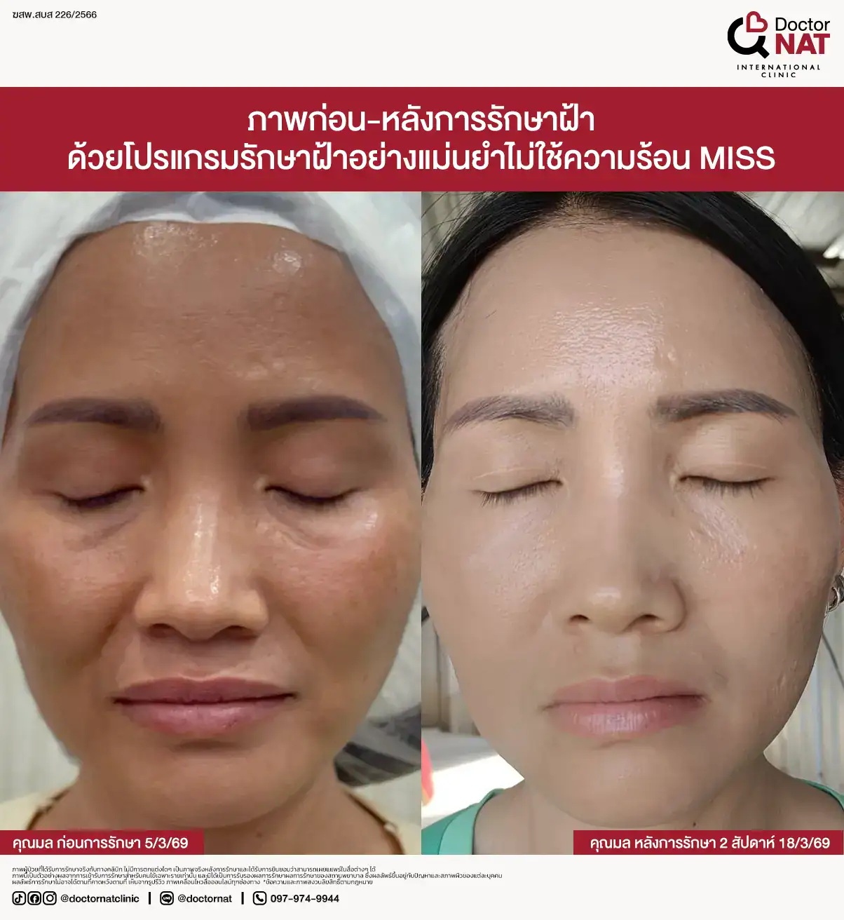 แนวทางรักษาฝ้าแบบ 3 มิติ ลดโอกาสฝ้ากลับมาเป็นซ้ำ