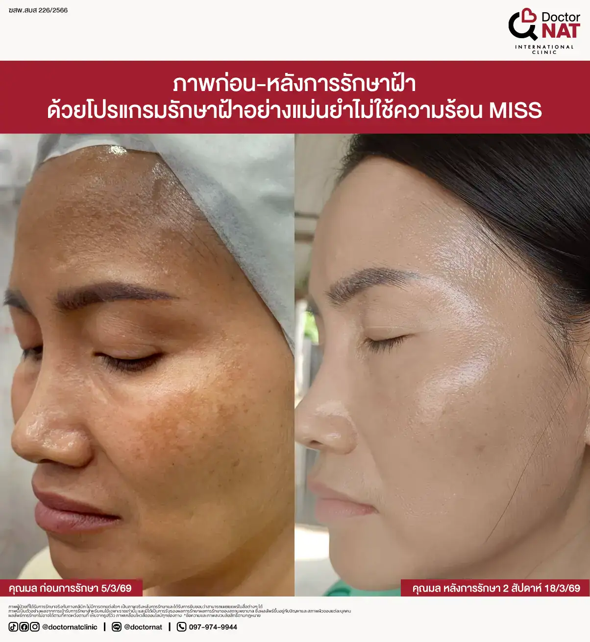วางแผนรักษาฝ้าเฉพาะบุคคลด้วยข้อมูลจาก Melasma Mapping 3D